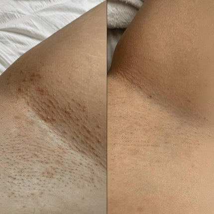 Before and after — post-acne marks, Brianna