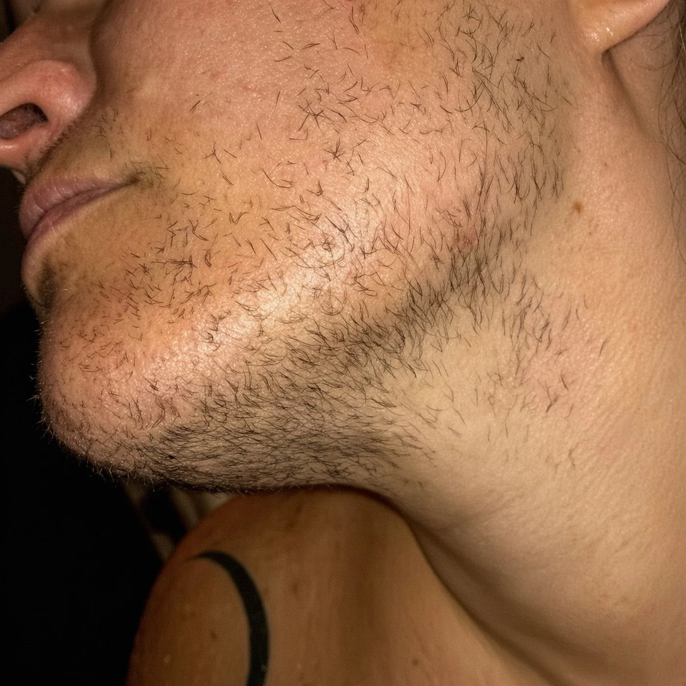 Before and after — day 1 of treatment